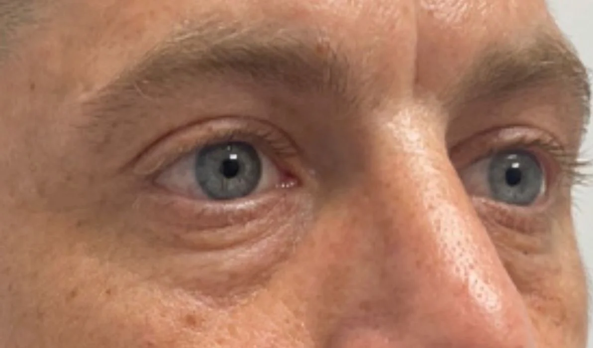 Antes de la eliminación de ojeras - paciente 1