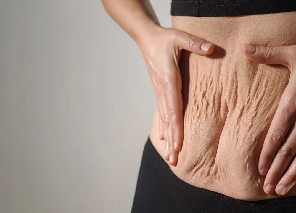 en que consiste la Abdominoplastia