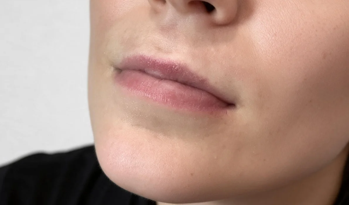 Aumento de labios - paciente 2