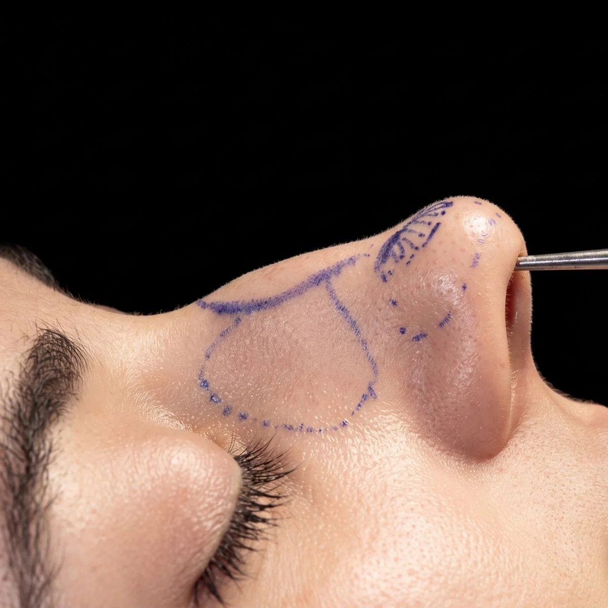 Rinoplastia en Clínicas Dorsia
