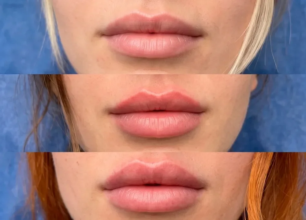 Modalidades del aumento de labios