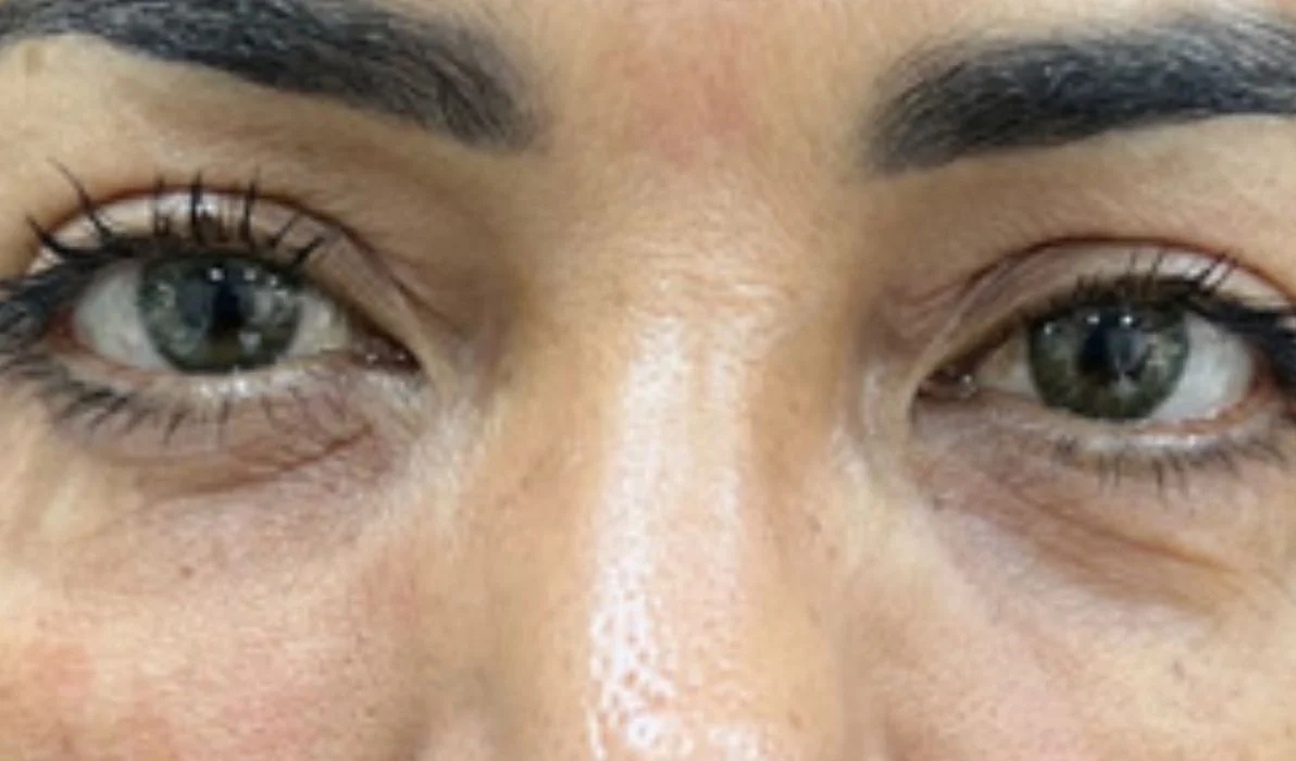 Después de la eliminación de ojeras - paciente 3